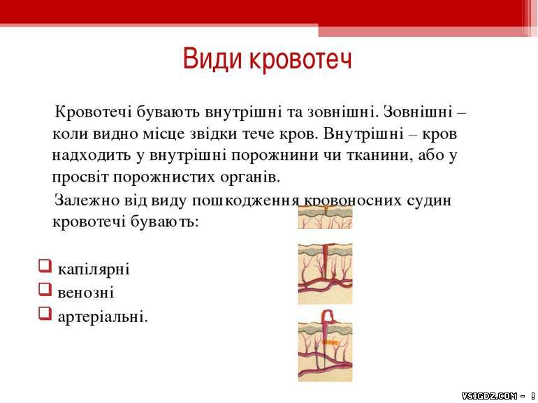 Презентація "Види кровотеч"